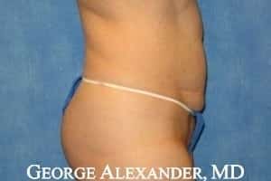 Breast Size